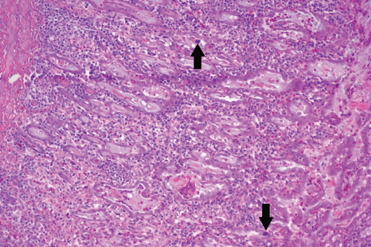 Figure 1. There are two basophilic intranuclear inclusion bodies in the glandular epithelial cells (arrows). There are mononuclear cells (round basophilic cells) infiltrating the mucosa and there are granulocytes (smaller eosinophilic cells). Photo courtesy of Christopher Poulos at APHA Lasswade.